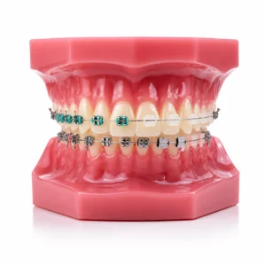 Model of a human upper and lower teeth with braces showing orthodontic treatment on a pink dental stand
