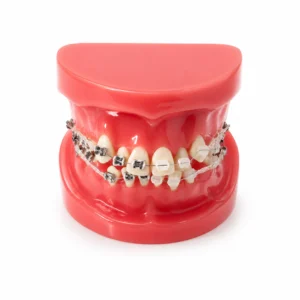 Red dental model showing braces on both upper and lower teeth for orthodontic demonstration.