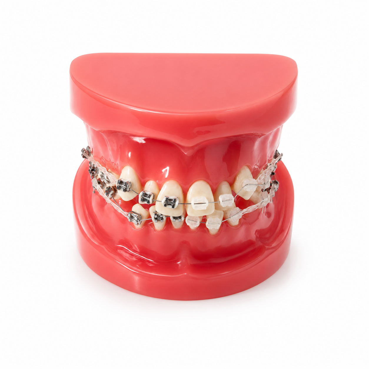Red dental model showing braces on both upper and lower teeth for orthodontic demonstration.