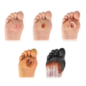 Collage of several feet with varying wounds: small circular ulcer on the ball of the foot, a red crater-like sore, a large deep ulcer around the big toe area, and a severely damaged, darkened foot suggesting advanced tissue loss.